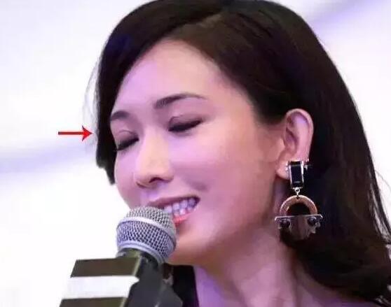 双眼皮留疤恐怖吗?怎么处理?