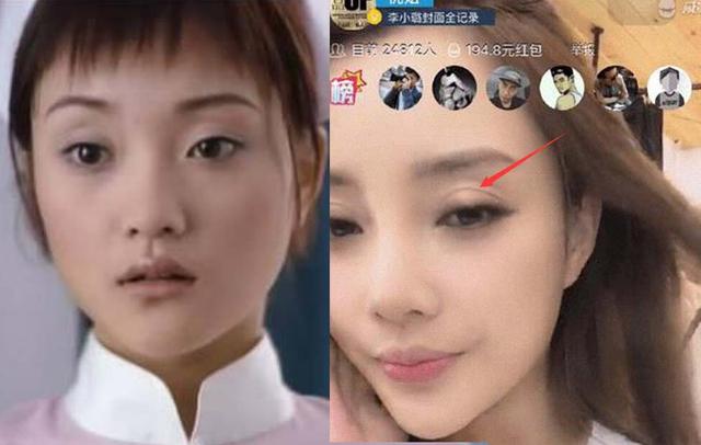 双眼皮留疤恐怖吗?怎么处理?