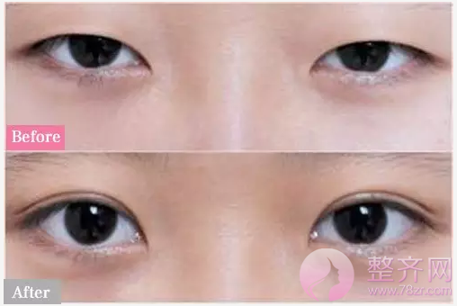 双眼皮问题,你的“窗户”有小心机吗?