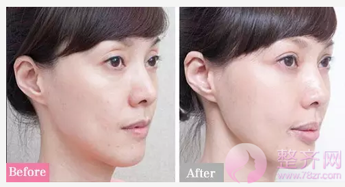 双眼皮问题,你的“窗户”有小心机吗?