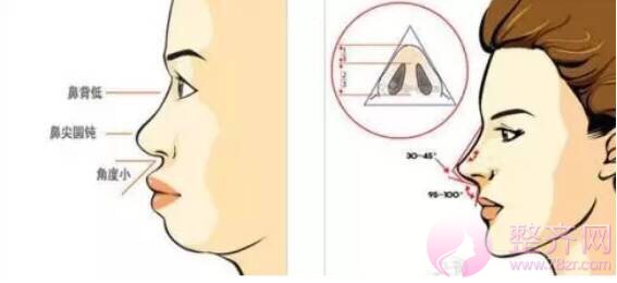 什么是综合隆鼻手术?