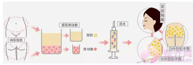 自体脂肪移植为何如此受欢迎?