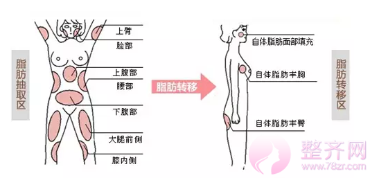 自体脂肪移植为何如此受欢迎?