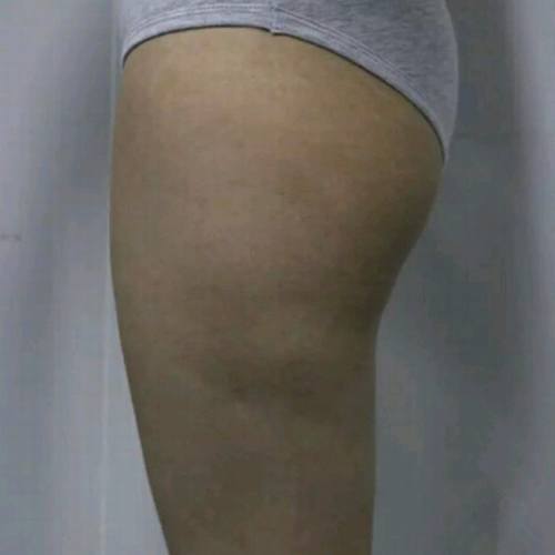 上海百达丽顾清吸脂怎么样?多少钱?案例?