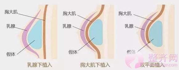 假体隆胸手感硬还不能剧烈运动?No!