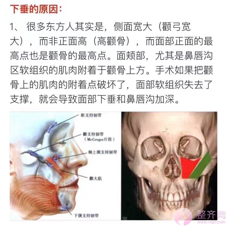磨颧骨到底会不会下垂?