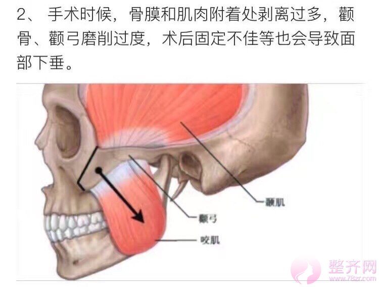 磨颧骨到底会不会下垂?