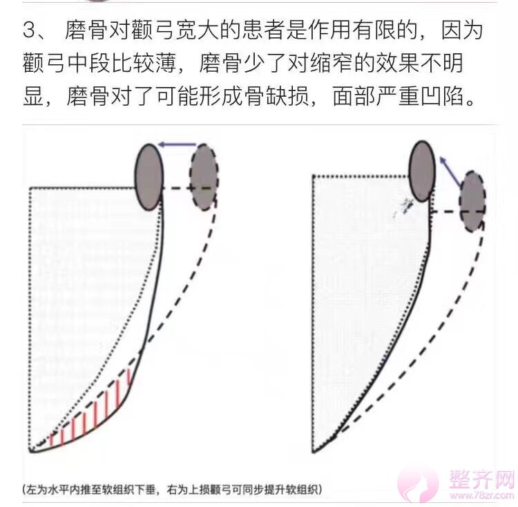 磨颧骨到底会不会下垂?