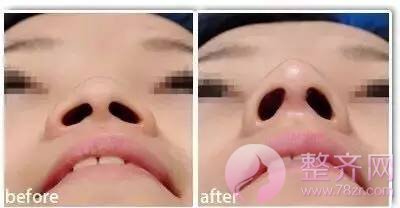 隆鼻能让脸变瘦,你相信吗