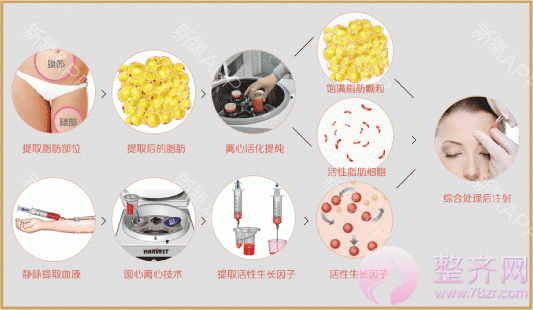 自体脂肪丰苹果机,让你笑的更自然、更迷人!