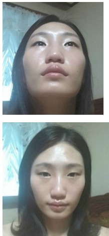 为了男朋友改变自己!大家看看我磨颧骨做的怎