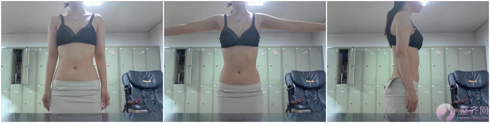 自体脂肪隆胸,环吸(手臂、腹部)术后1年的后