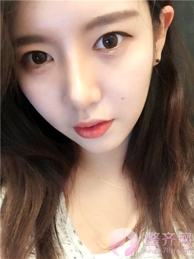 定制鼻整形,脂肪填充术后8个月后记