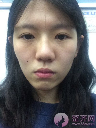 定制鼻整形,脂肪填充术后8个月后记