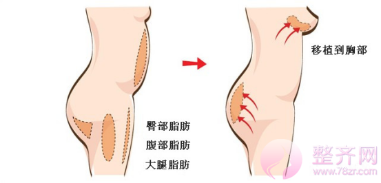 丰胸又瘦腰,自体脂肪隆胸到底好不好?