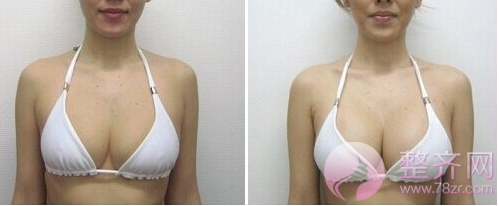 丰胸又瘦腰,自体脂肪隆胸到底好不好?