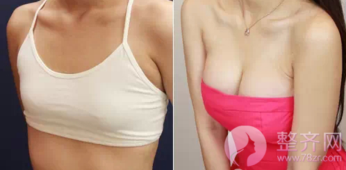 丰胸又瘦腰,自体脂肪隆胸到底好不好?