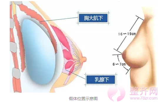 假体隆胸会影响哺乳吗?