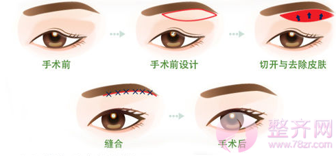 眼睑下垂矫正术,凸显眼部魅力