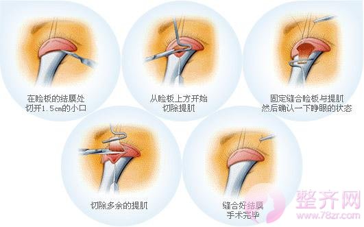 眼睑下垂矫正术,凸显眼部魅力