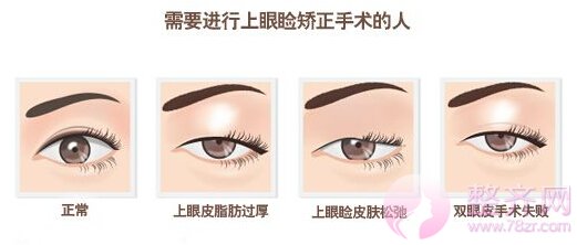 眼睑下垂矫正术,凸显眼部魅力