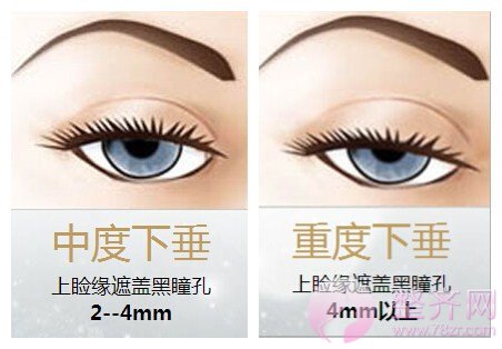 眼睑下垂矫正术,凸显眼部魅力