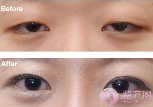 眼睑下垂矫正术,凸显眼部魅力