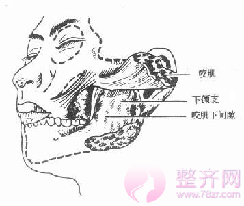 祛除咬肌,让你成为小脸女人