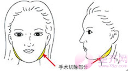 祛除咬肌,让你成为小脸女人