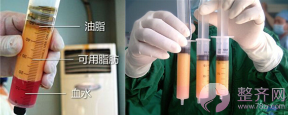 脂肪填充让你拥有童颜!