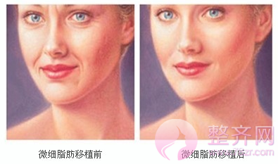 脂肪填充让你拥有童颜!
