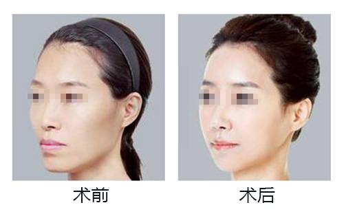 自体脂肪丰太阳穴果好吗?多少钱?