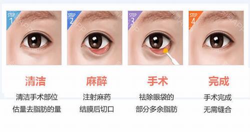 内切祛眼袋好不好?多少钱?