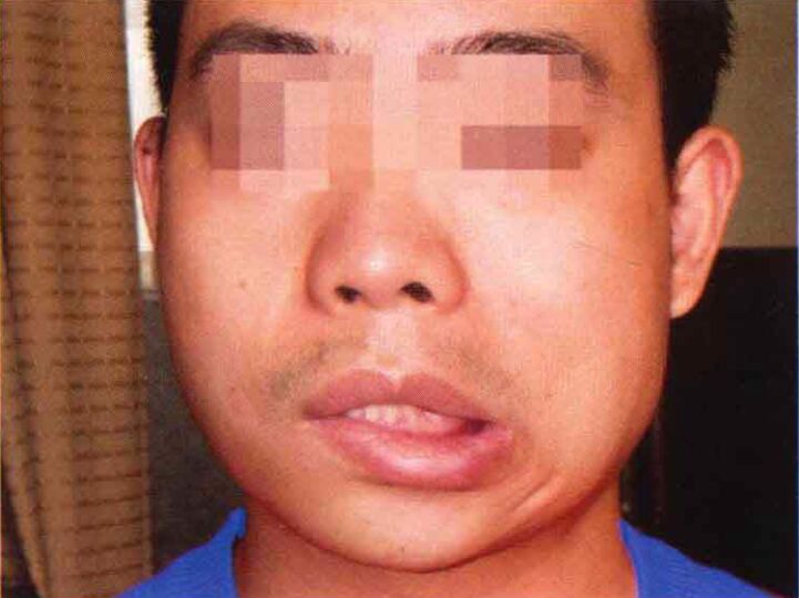 注射瘦脸也能治疗面瘫,你知道吗?