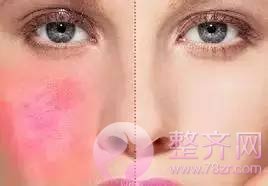 脸部红血丝泛滥应该怎么改善?