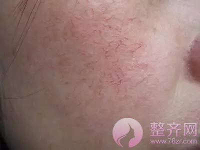 脸部红血丝泛滥应该怎么改善?
