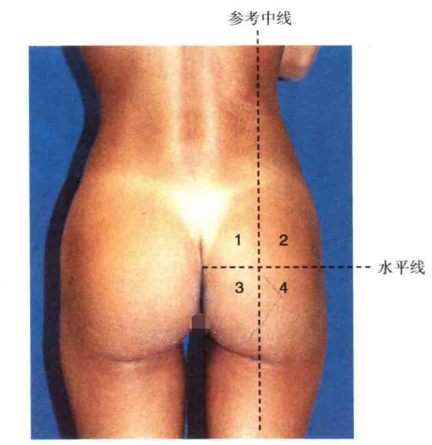 哪些人适合做丰臀,怎样的臀部才好看?