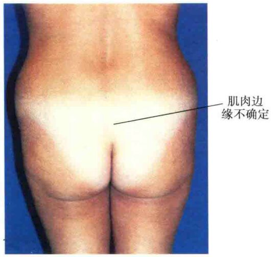 哪些人适合做丰臀,怎样的臀部才好看?