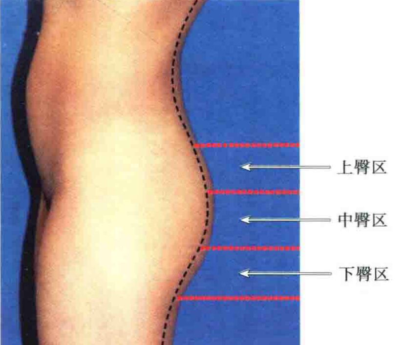 哪些人适合做丰臀,怎样的臀部才好看?