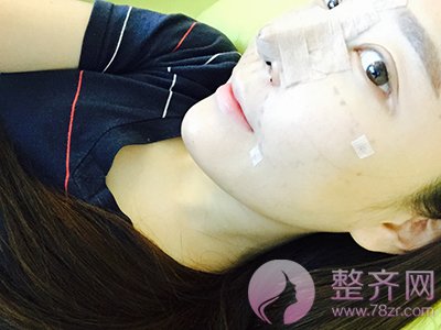 自体脂肪面部移植,硅胶隆鼻案例
