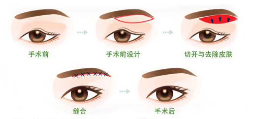 上眼睑下垂怎么办?手术费用多少钱?