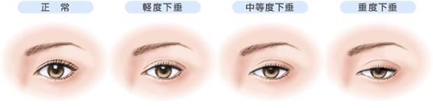 上眼睑下垂怎么办?手术费用多少钱?