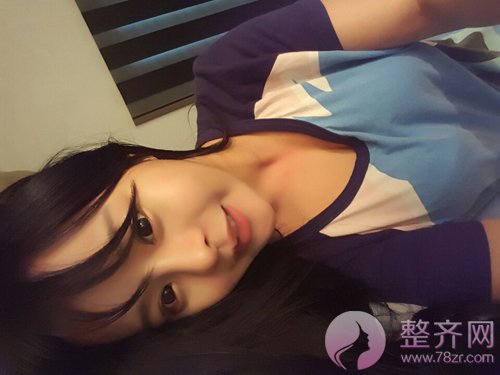 隆鼻修复手术改变了我的一生!