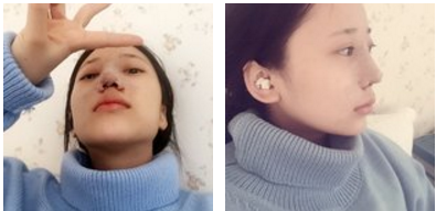 鼻骨矫正是怎么样的?多少钱?
