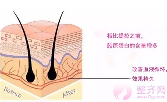 如何改善皮肤松弛下垂?