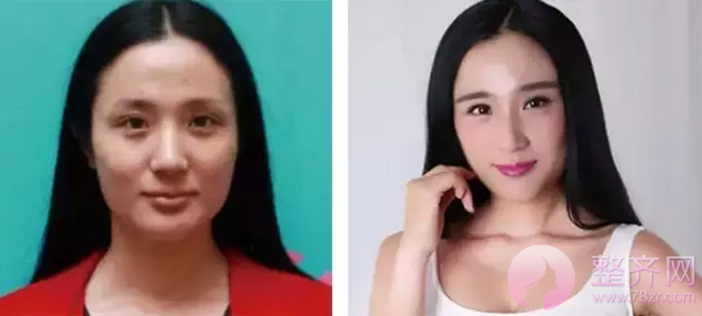 如何改善皮肤松弛下垂?