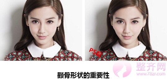 “无下垂颧骨移动术”,韩国妹子为啥都是小半