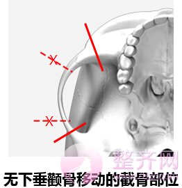 什么是无下垂颧骨移动术?