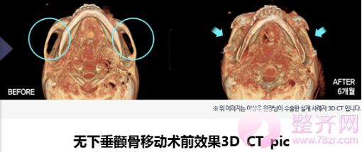 什么是无下垂颧骨移动术?