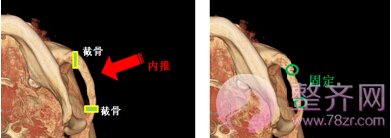 什么是无下垂颧骨移动术?